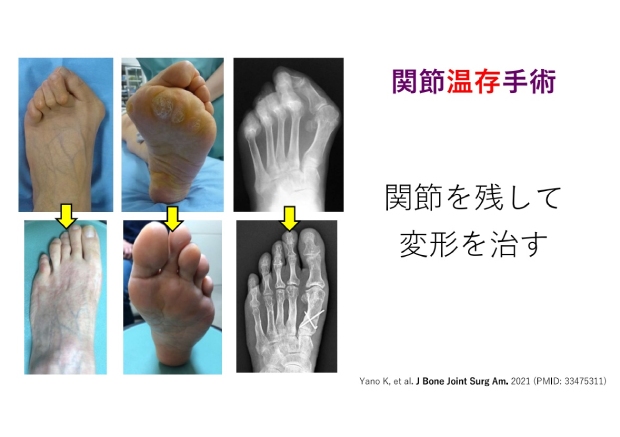 関節温存手術