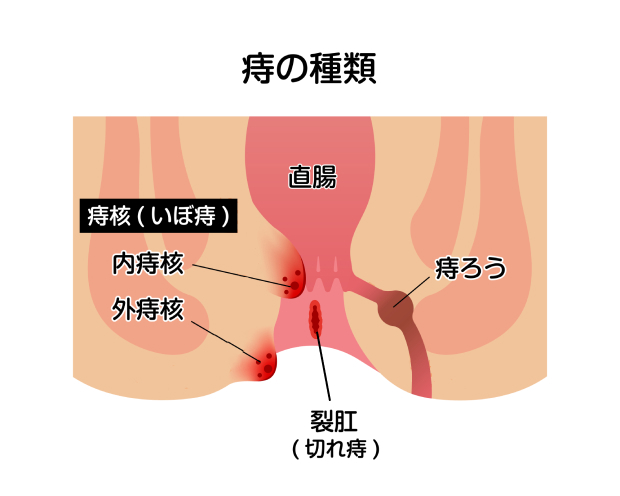 肛門の疾患