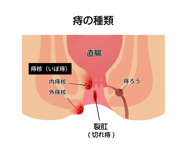 痔
