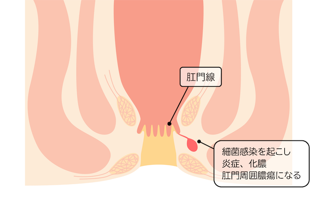肛門周囲膿瘍から痔ろうへ（イメージ：PIXTA）