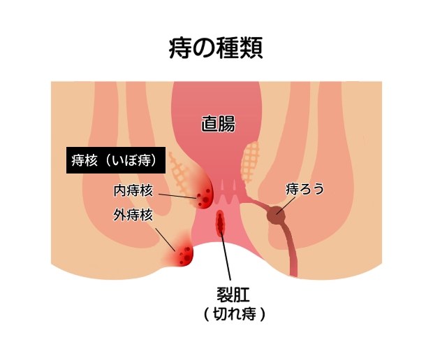 痔の種類
