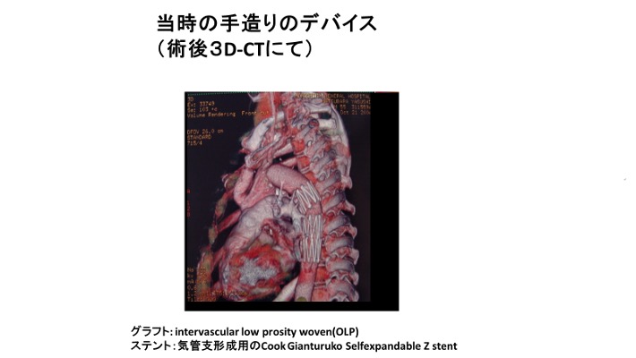 日本発の治療が世界へ――オープンステントグラフト治療の開発の軌跡