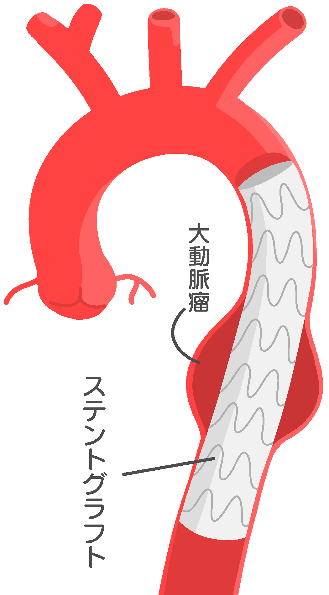 イラストでわかる実施困難症例の大動脈ステントグラフト Visualizatio… イラストでわかる実施困難症例の大動脈ステントグラフト | 宮本