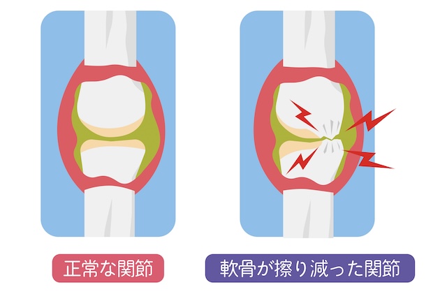 変形性膝関節症