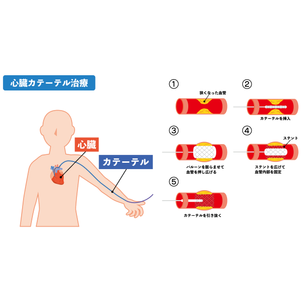心臓カテーテル治療（提供：PIXTA）
