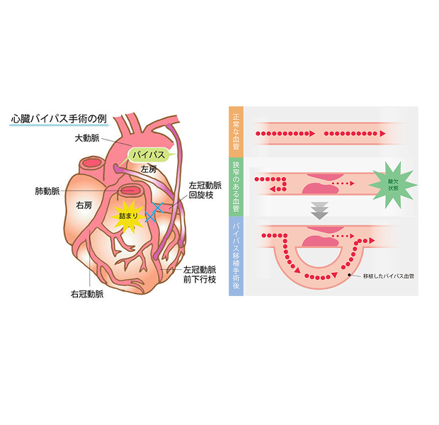 冠動脈バイパス手術（提供：PIXTA）