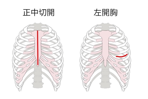 正中切開と左開胸