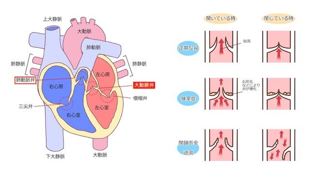 大動脈弁狭窄症・閉鎖不全症（画像提供：PIXTA）