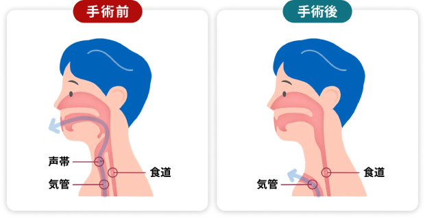 喉頭（声帯）摘出術とは？