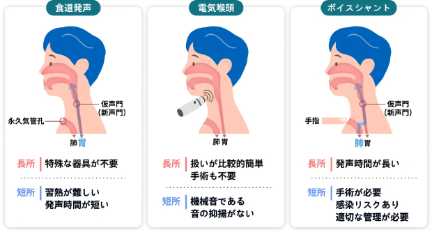 喉頭摘出後の代表的な3つの代用発声法