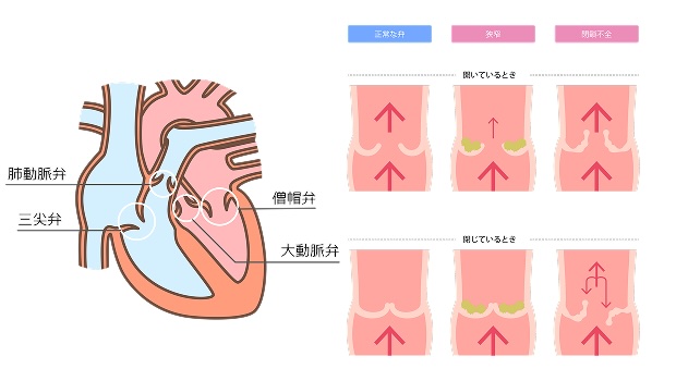 心臓弁膜症（イラスト：PIXTA）